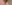 裏ハムラ法（経結膜的眼窩脂肪移動術） — アンド美容外科クリニック