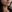 Thread lift — Wivers Plastic Surgery Clinic