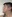 Double chin liposuction (submental liposuction) — Myong Plastic Surgery & Aesthetics