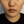 โบท็อกซ์ปีกจมูก — ก่อนทำ (14วัน) · คลินิก Only P