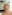 revision eyelid surgery (secondary blepharoplasty) — DA Plastic Surgery Clinic