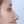 Nasal tip augmentation with donor (acellular) dermal matrix — before (15days) · Thank You Plastic Surgery