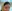 Forehead filler (hyaluronic acid) — Kody Plastic Surgery Clinic