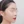 前頬骨への脂肪注入 — 術後 (30日) · プレジャー美容外科クリニック