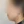 Belotero Revive (HA + glycerol skinbooster) — after (30days) · Vuraval Plastic Surgery Clinic