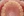 MTA orthodontics (Mini-Tube Appliance partial braces) — before (157days) · Lucent Dental Clinic