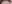額リフト（前額リフト） — DM美容外科クリニック