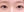 Eyelid filler (upper eyelid hollowing correction) — after · Sinsa Cerea Clinic