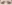 二重まぶた（自然癒着法） — イーエス清潭美容外科クリニック
