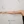 Arm liposuction — after (7days) · D-Light Surgery Clinic