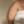 Shoulder lipolysis injection (fat-dissolving injection) — before (21days) · Pleasure Plastic Surgery Clinic