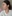 裏ハムラ法（経結膜的眼窩脂肪移動術） — ジャスト美容外科クリニック