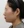 ฉีดสลายไขมันหน้า (เมโสแฟตแก้ม) — ก่อนทำ · ศูนย์ศัลยกรรม Zero - สาขาชินซา