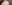 額縮小術（生え際下げ・ヘアライン下降術） — コウユ美容外科クリニック