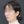 two-jaw surgery (bimaxillary orthognathic surgery) — before (40days) · ReFace Dental Hospital
