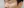 ฟิลเลอร์ใต้ตา (แก้ร่องใต้ตา / ขอบตาคล้ำ) — หลังทำ · คลินิกยูพิค สาขาซองโด