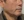 Radiesse (calcium hydroxylapatite filler / biostimulator) — after · Ripain Clinic