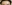 額縮小術（生え際下げ・ヘアライン下降術） — コウユ美容外科クリニック