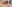 Under-eye (tear trough) fat grafting — Eight Plastic Surgery Clinic