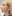 Full-face fat grafting (autologous fat transfer) — Anersty Plastic Surgery Clinic