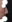 Bulbous nose correction (surgical nasal tip reduction) — Eight Plastic Surgery Clinic