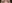 Lateral canthoplasty (outer corner opening) — Uri Plastic Surgery Clinic