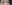 Lower Eyelid Fat Repositioning (transconjunctival) — Pop Plastic Surgery Clinic