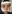 Revision facial contouring surgery (secondary facial bone surgery) — Uri Plastic Surgery Clinic