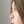 Nasal osteotomy (nasal bone narrowing) — before (7days) · Code Plastic Surgery Clinic