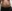 Double chin liposuction (submental liposuction) — Seoul During Clinic