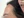 Aegyo-sal filler (under-eye 'love band' / pretarsal roll filler) — before · Monster Clinic