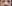 Nasal Tip Plasty with Autologous Cartilage — Uri Plastic Surgery Clinic