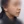 下巴異物取出（下巴假體移除） — 術前 (30天) · Returning醫美診所