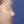 Short nose correction (nose lengthening / derotation) — after (13days) · Yeonse Kyeol Plastic Surgery Clinic