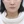 颈部提升术（颈纹拉皮） — 术后 (14天) · 丽莫医美诊所