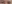 Ptosis Correction (levator surgery / eye-shape correction) — DM Plastic Surgery Clinic