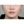 ผ่าตัดลดโหนกแก้มแบบเร็ว (ไม่ใส่ตัวยึด) — หลังทำ (90วัน) · ID Hospital - โรงพยาบาลหลัก