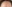 額縮小術（生え際下げ・ヘアライン下降術） — ザフィックス美容外科クリニック