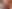 裏ハムラ法（経結膜的眼窩脂肪移動術） — エイペックス美容外科クリニック