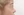 Short nose correction (nose lengthening / derotation) — after (14days) · iLumi Plastic Surgery Clinic