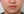 JUVGEN (autologous dermal regeneration / collagen-induction injection) — after (14days) · Saeroun Plastic Surgery