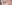Ptosis Correction (levator surgery / eye-shape correction) — Uri Plastic Surgery Clinic