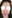 Bulbous nose correction (surgical nasal tip reduction) — Coco Line Clinic