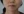 Thread lift — after · La Derma Clinic