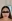 Forehead reduction (hairline lowering surgery) — Uri Plastic Surgery Clinic