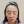 Scalp hair transplant — before (10days) · Okgeon Hairline Clinic