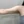 Brachioplasty (arm lift) — before (30days) · Cheongdam OK Plastic Surgery Clinic