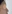 Septoplasty (deviated nasal septum correction) — Kobi-Ju Clinic