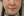 Oligio / Oligio X (โอลิจิโอ) — หลังทำ (30วัน) · เยพึนออลกุลคลินิก
