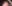 生え際の植毛（ヘアライン植毛） — ソジン美容外科クリニック